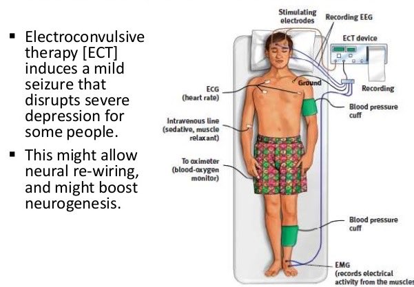 Learn Electroconvulsive Therapy AP Psychology Definition (Get The Key Concepts Now)